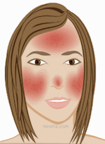 rosacea symptoms late-stage
