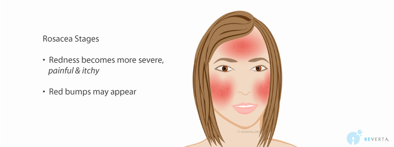 rosacea stage 4